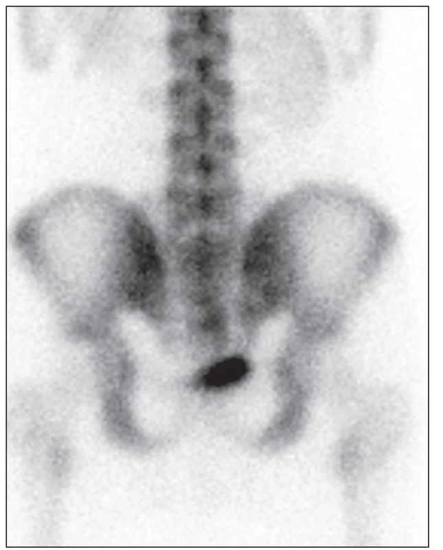 &lt;i&gt;Třífázová scintigrafie skeletu – 3. fáze (zadní pohled): v oblasti os sacrum vpravo nedochází ke zvýšené akumulaci radiofarmaka&lt;/i&gt;