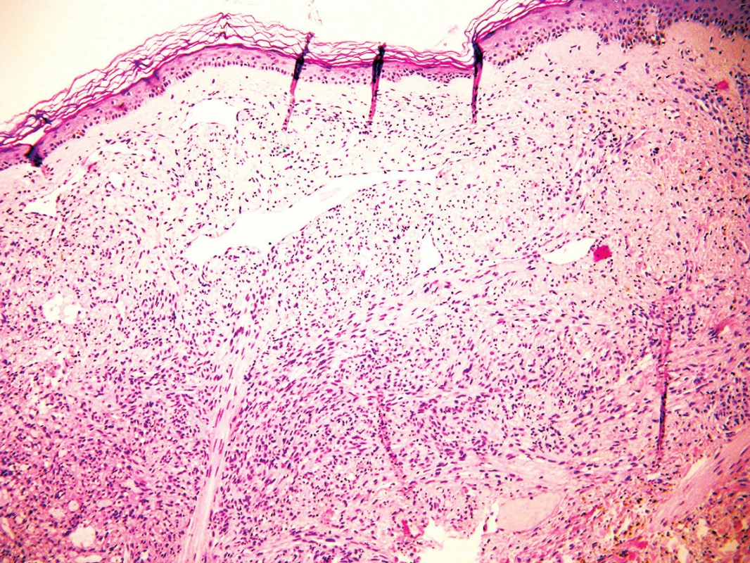 Histologický obraz; nepravidelně tvarované tenkostěnné cévy, ve svazcích uspořádané vřetenité buňky, hyperchromní jádra, v okolí přítomna depozita hemosiderinu a perivaskulárně malé infiltráty lymfocytů a plazmocyty