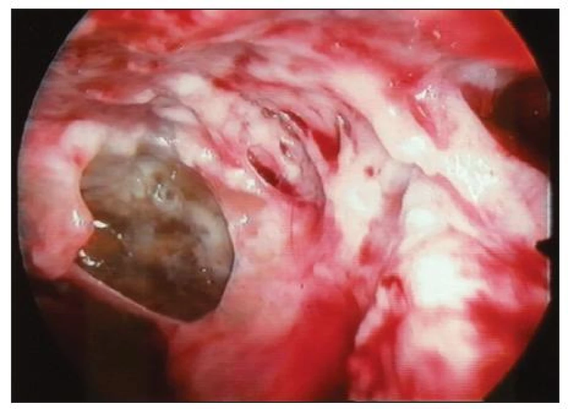 Peroperační snímek chronického pleurálního empyému při VTS
Fig. 3. Intraoperative view of chronic pleural empyema during VTS