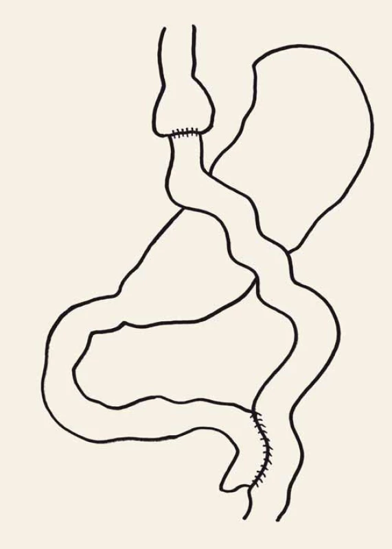 Roux-Y gastrický bypass.
Fig. 3. Roux-en-Y gastric bypass.