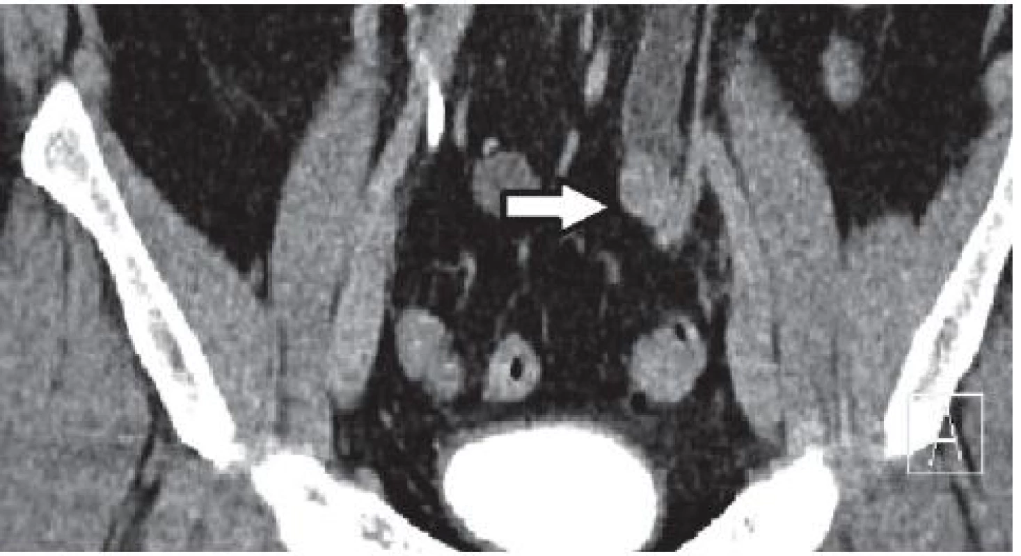 CT po podání intravenózní kontrastní látky – šipka ukazuje na tumor močovodu
Fig. 3. CT after administration of intravenous contrast material – the arrow points to the tumor ureter