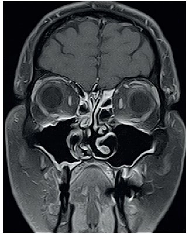 MRI očnic T1 vážený obraz, FSAT, koronární řez, kontrast Dotarem – bez opacifikace, bez infiltrátu