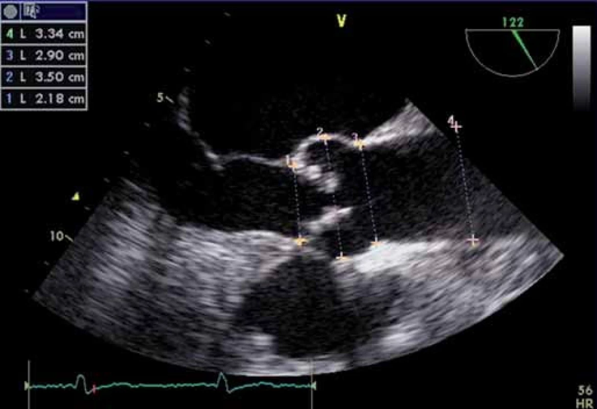 Transezofageální echokardiografie – měření velikosti prstence (1), bulbu (2), sinotubulární junkce (3), vzestupné aorty (4) – standardní měření anatomických poměrů před TAVI.