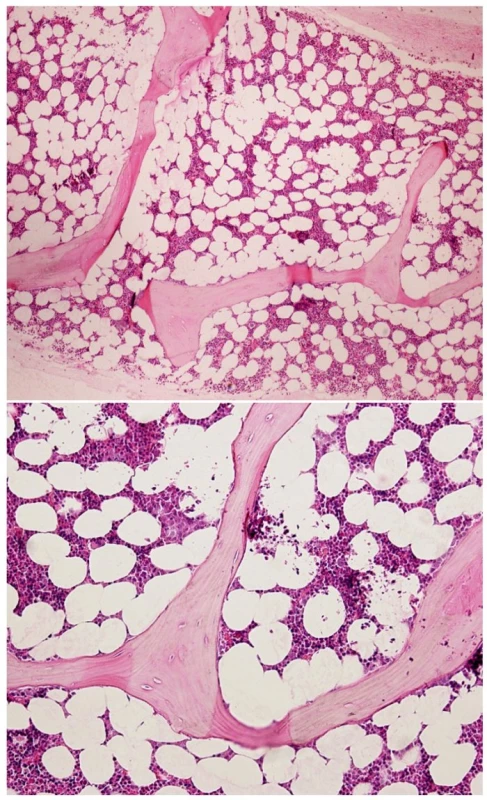 Photomicrographs of a histological section from bone marrow core biopsy showing normocellular marrow without intrasinusoidal infiltration of lymphoma
A) H &amp; E stain, original magnification x 4, B) H &amp; E stain, original magnification x 10