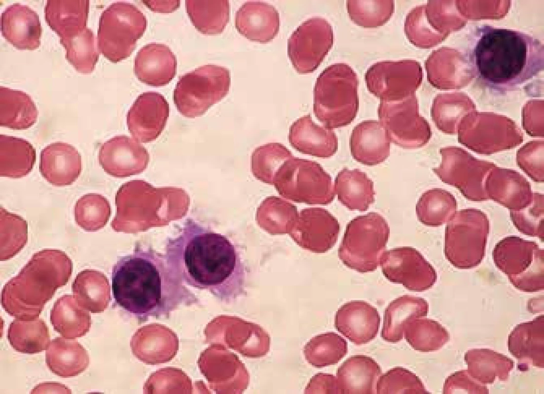 SMZL, vilózní lymfocyty (malé lymfocyty s hutným jaderným chromatinem a bohatou nepravidelnou cytoplazmou vybíhající unipolárně či bipolárně v četné výběžky)