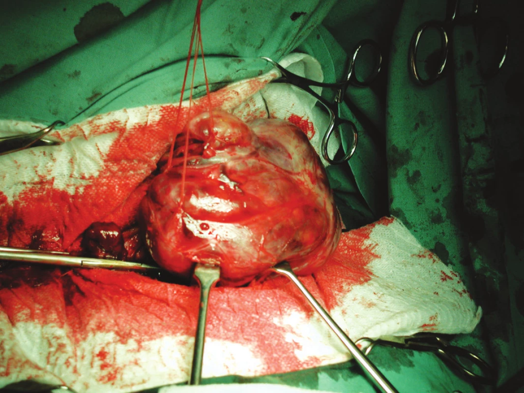 Peroperační foto – odpreparovaný rozsáhlý uzel, který komprimoval tracheu.
Fig. 1. An intraoperative photograph – dissected large thyroid nodule that compressed the trachea