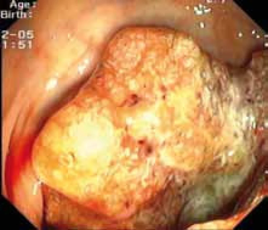 Endoskopický obraz kolorektálního karcinomu.