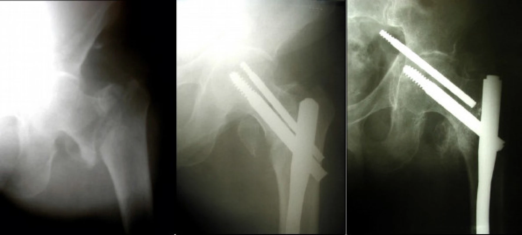 muž, 62 let, s mnohočetným myelomem, utrpěl při pádu nestabilní pertrochanterickou zlomeninu levého femuru (a), provedena osteosyntéza krátkým PFN (b), po 16 týdnech prokázána centrální migrace antirotačního šroubu a perforace hlavice nosným šroubem (c)