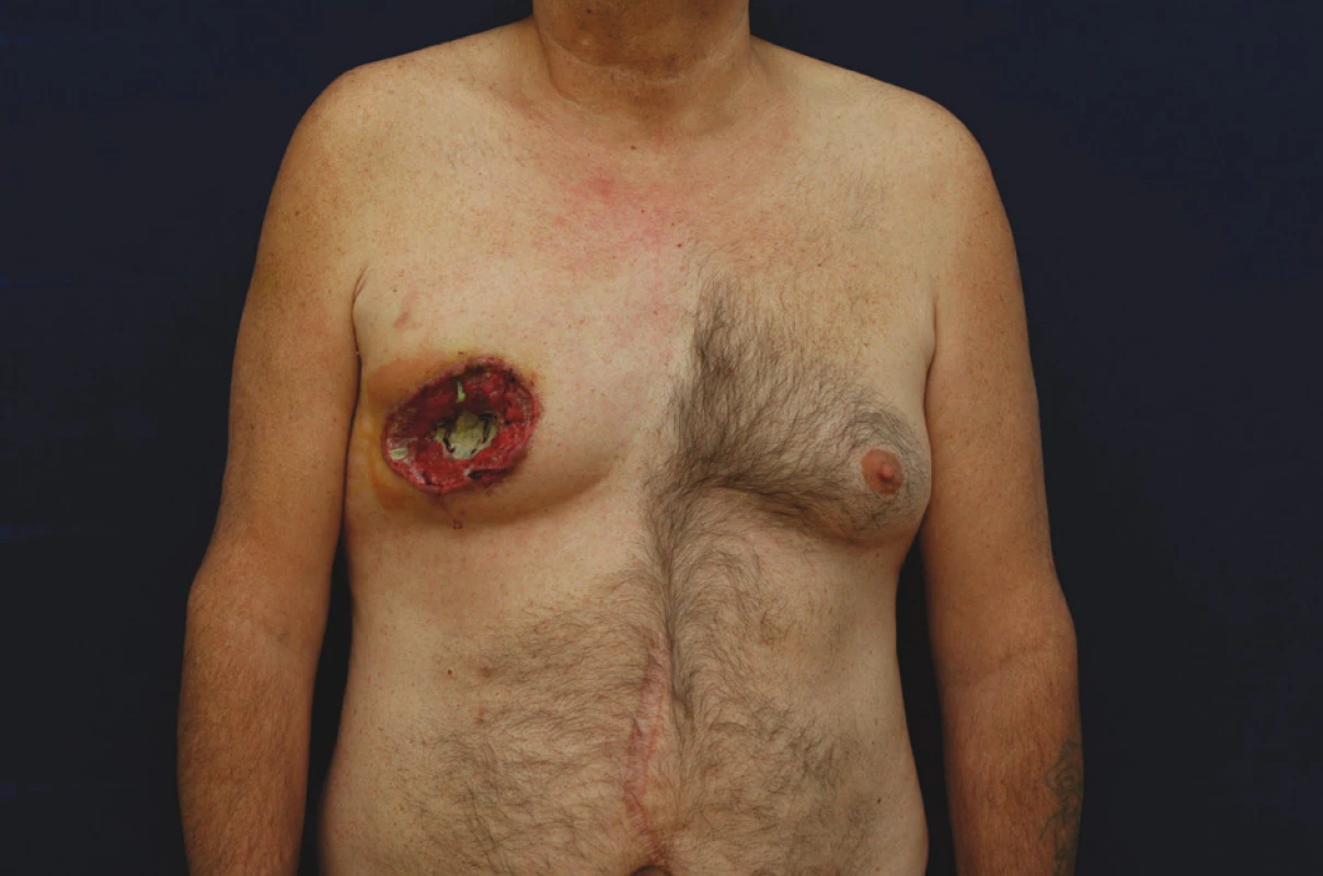 Mužský karcinomu prsu – exulcerovaná forma
Fig. 3. Male breast carcinoma – an exulcerated form