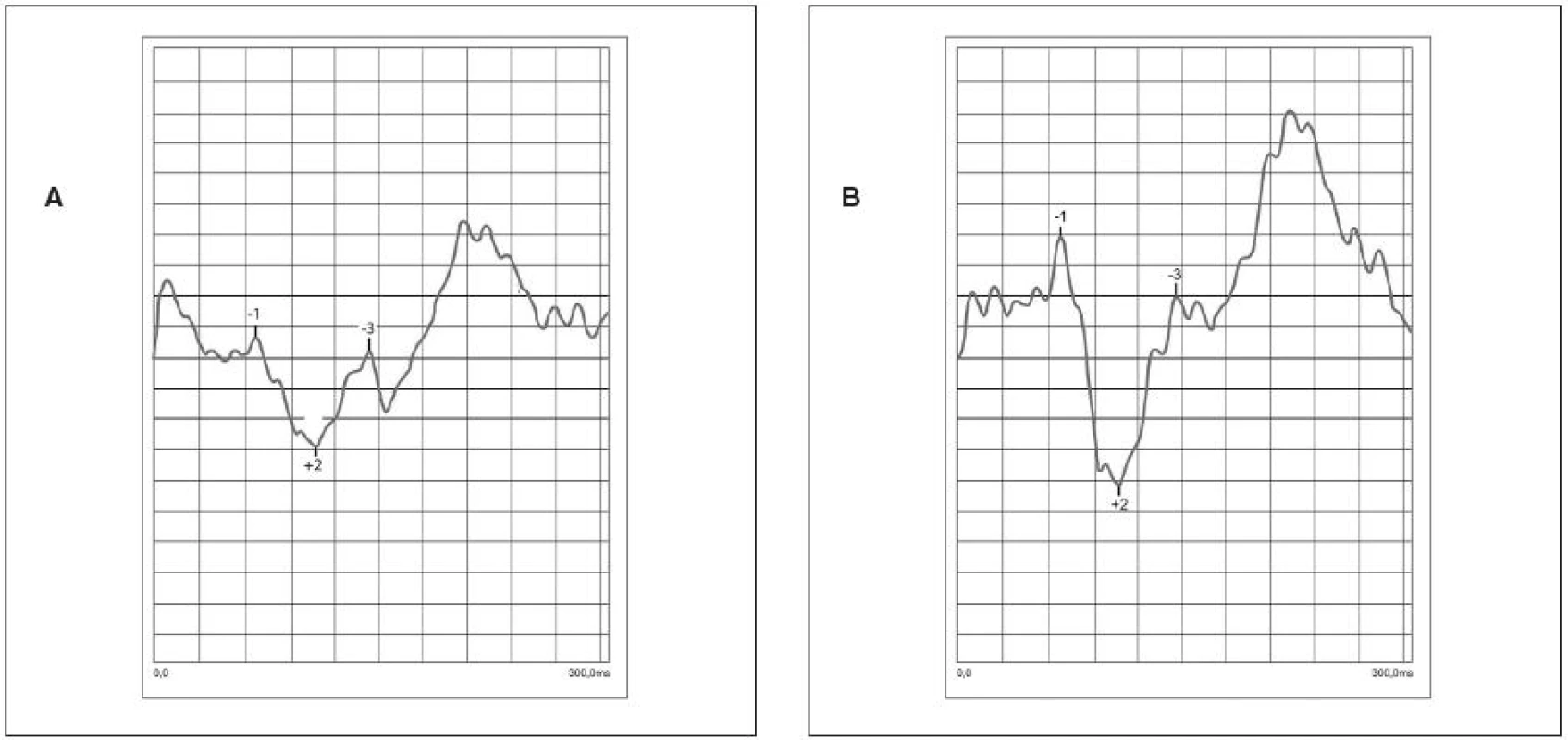 Porovnanie tvaru NPN komplexu u jednej pacientky pred započatím oklúznej liečby (a) a v priebehu oklúznej liečby (b) s úpravou zrakovej ostrosti o 2 riadky Snellenových optotypov. Nastalo zlepšenie v predĺžení amplitúd aj skrátení latencií
