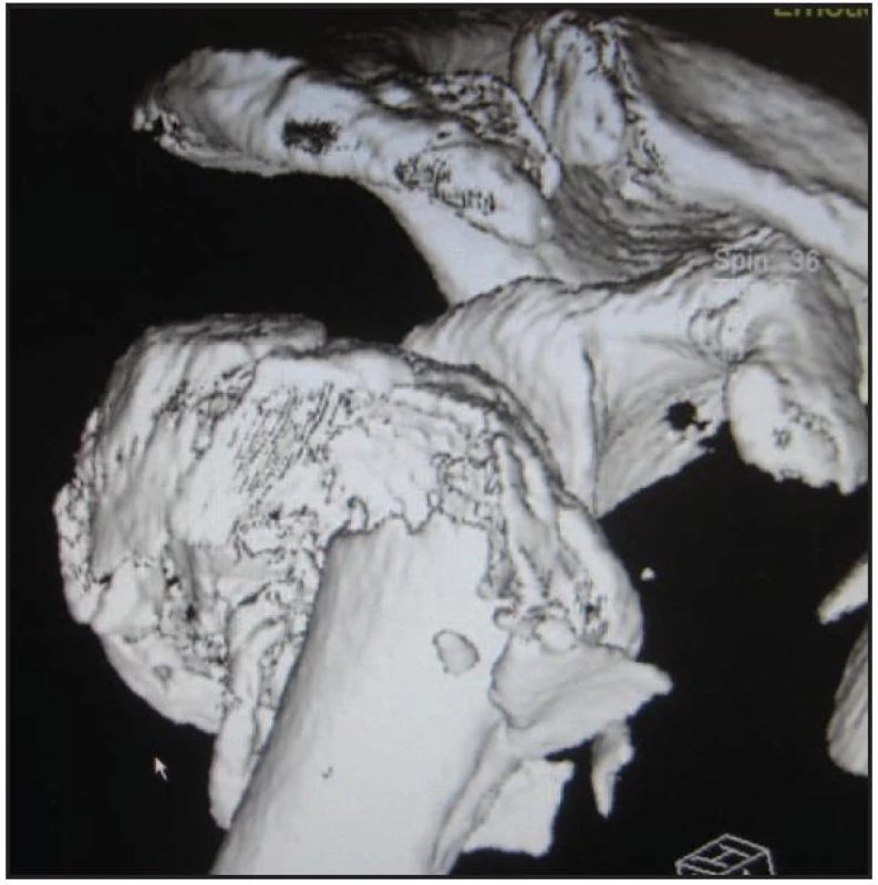 CT obraz tříštivé zlomeniny proximálního humeru
