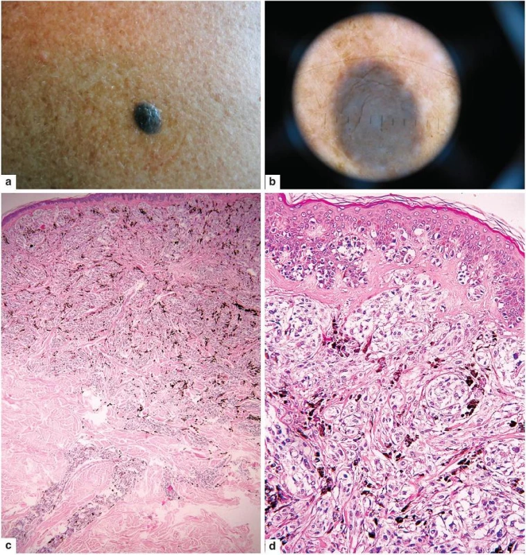 Hluboko penetrující névus
a – černomodrý tuber
b – bezstrukturní šedomodrý okrsek s ojedinělou drobnou hnědou globulí uprostřed v dermatoskopickém obrazu. Je zřejmé, že veškerý melanin je v strukturách v koriu s minimem změn v epidermis.
c – hluboko sahající, rovnoměrně pigmentovaný tumor
d – detail na povrchní část ukazuje nevýraznou složku junkční a v koriu epiteloidní a vřetenité melanocyty s četnými melanofágy