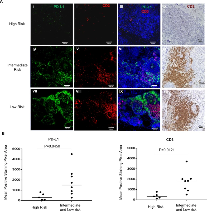 T-cell infiltrates and programmed cell death-ligand 1 (PD-L1) tumor expression are associated with risk stratification in human neuroblastoma.