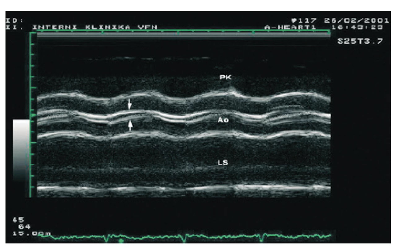 Aortální stenóza v parasternální projekci M-modu, AS MM
