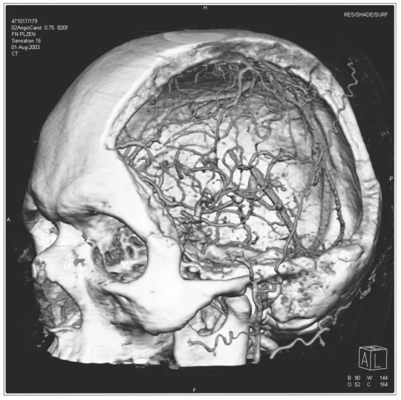 3D CT zobrazující rozsáhlou hemisferální dekompresivní kraniektomii
Pic. 1. 3D CT depicting extensive hemispheral decompressive craniectomy