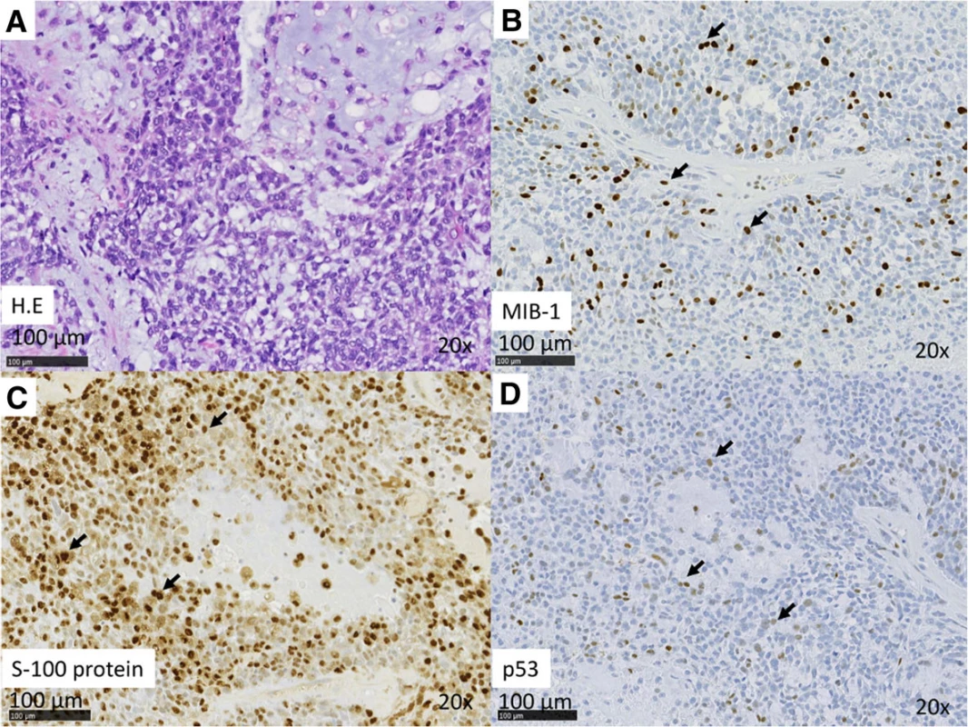 (a–d) Case 1. Histopathologic features of MEC. a H&amp;E stain. b IHC analysis reveals Ki67 positivity in nuclei. The MIB index was approximately
20 %. c IHC analysis revealed S-100 positivity in the cytoplasm. d IHC analysis revealed p53 positivity in the nuclei