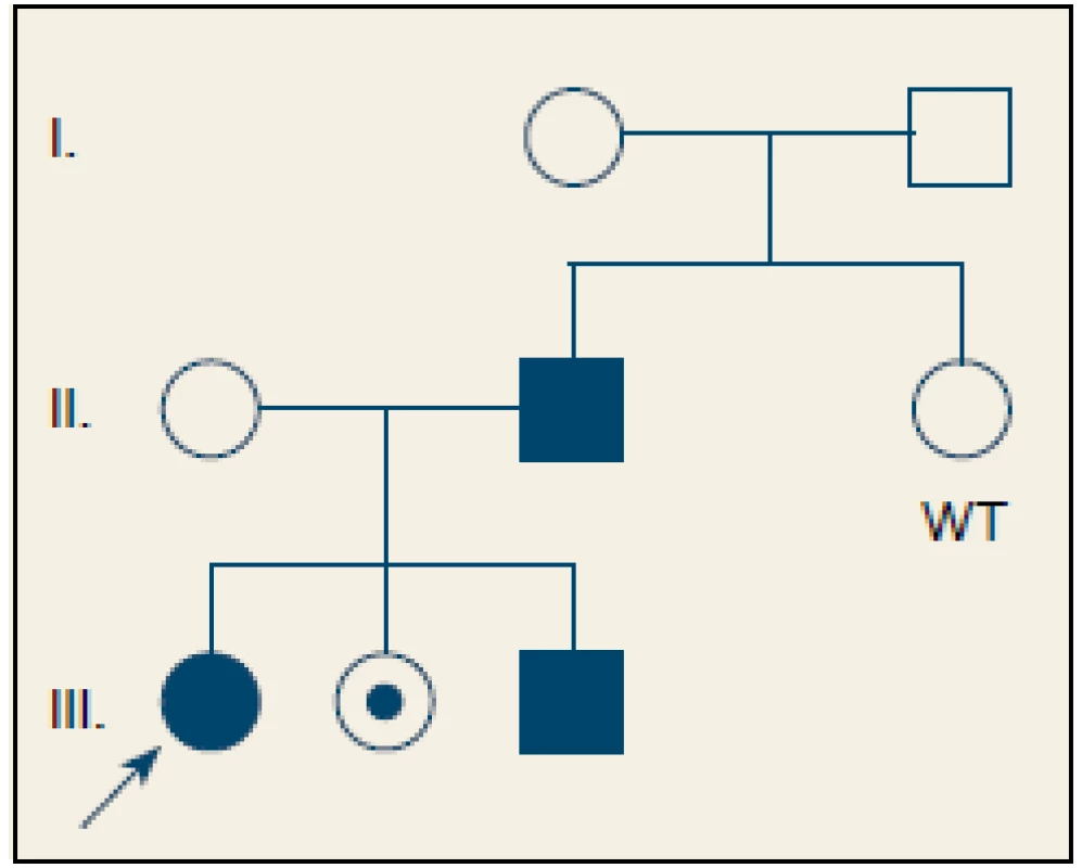 Rodokneň pacienta s hereditárnou pankreatitídou. Čiernou sú označení jedinci s chronickou pankreatitídou a potvrdenou heterozygotnou mutáciou p.R122H génu PRSS1. Bodkou je označený zdravý nosič mutácie. Zdravý jedinec bez mutácie je označen jako WT – wild type. Šípka smeruje na pacientku zaradenú do štúdie.
Fig. 2. Family tree of a patient with hereditary pancreatitis. Individuals with chronic pancreatitis and confirmed heterozygous mutation in p.R122H of the PRSS1 gene are marked in black. A healthy carrier of the mutation is marked with a dot. A healthy individual without the mutation is marked with WT – wild type. The arrow points to the patient enrolled in the study.
