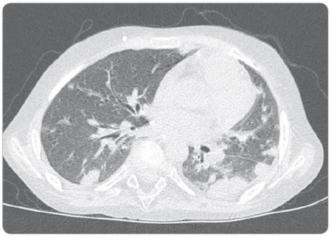 Natívny CT snímok hrudníka (30. 7. 2014).