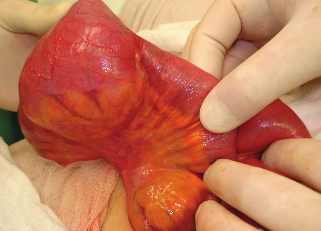 Lymfatické uzliny v závěsu ilea
Fig. 4: Lymph nodes in the mesentery