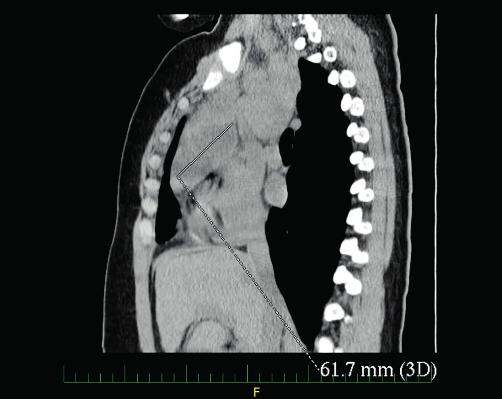 CT hrudníku – tekutinové kolekce v předním mediastinu.
Fig. 3. Chest CT – fluid collections of anterior mediastinum.