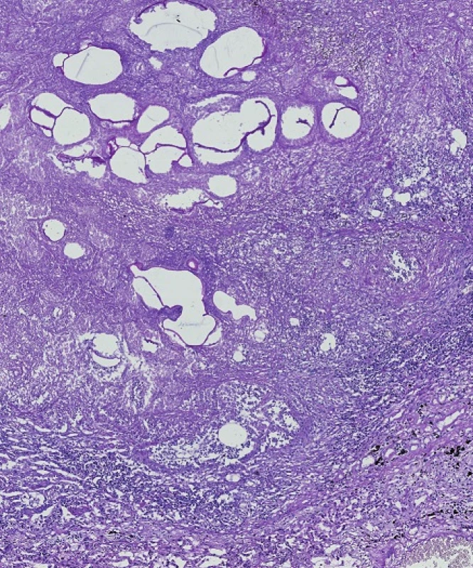 Ložisko cyst s PAS pozitivními membránami obklopené granulační tkání v pravé plíci. Barveno PAS (zvětšení 100x).