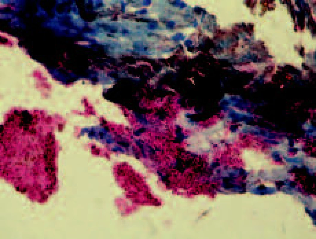 Četné červeně se barvící acido-alkohol stabilní mykobakterie ve velkých shlucích v kožním vředu čichavce perleťového (Trichogaster leeri); zvětšeno 40x (foto L. Novotný).