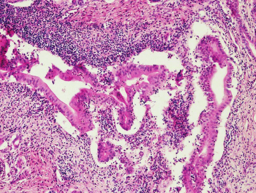Granulocytární epiteliální léze – denzní periduktální zánûtlivá infiltrace s destrukcí duktálního epitelu neutrofilními granulocyty. Barveno hematoxylinem eozinem (zvětšení 100x).