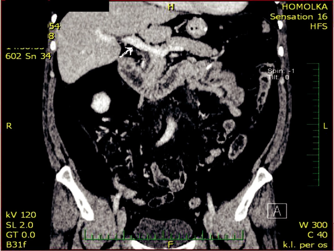 Kontrolní CT po 3 měsících v sagitálním řezu