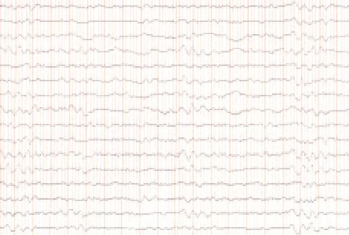 EEG v októbri roku 2005 – opakovane epizódy rytmickej δ-aktivity, amplitúdy 150–200 μV, s frekvenciou 1–2 Hz.