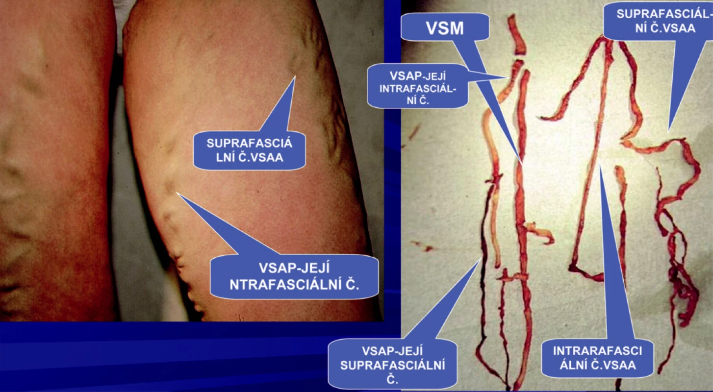 Extrakce celého safémového komplexu VSAA probíhá mimo HS. Z VSM odstupuje v HS pouze VSAP. 
Klinicky manifestní suprafasciální část přidatných safén VSAA a VSAP u téhož pacienta. Vlastní VSM nemá na stehně klinickou manifastaci, její průběh je intrafasciální.