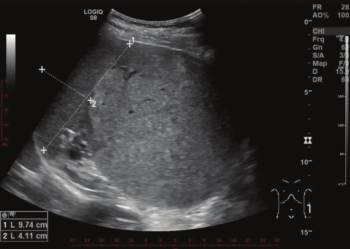 Zobrazení expanze levého hypochondria na ultrazvuku
Fig. 1: Ultrasound image of an expansion in the left hypochondrium