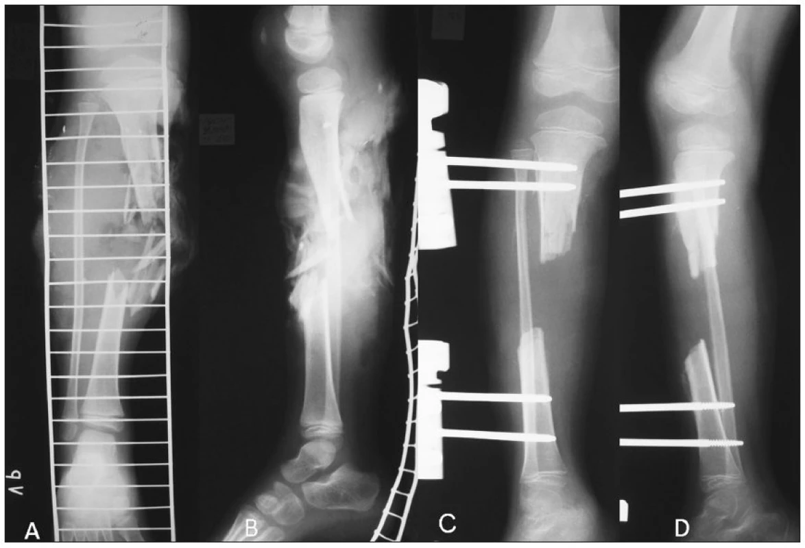a. Tibial shaft fracture – PA view
b. Tibial shaft fracture – lateral view
c. Tibial defect after debridement and stabilization by unilateral external fixator – PA view
d. Tibial defect after debridement and stabilization by unilateral external fixator – lateral view