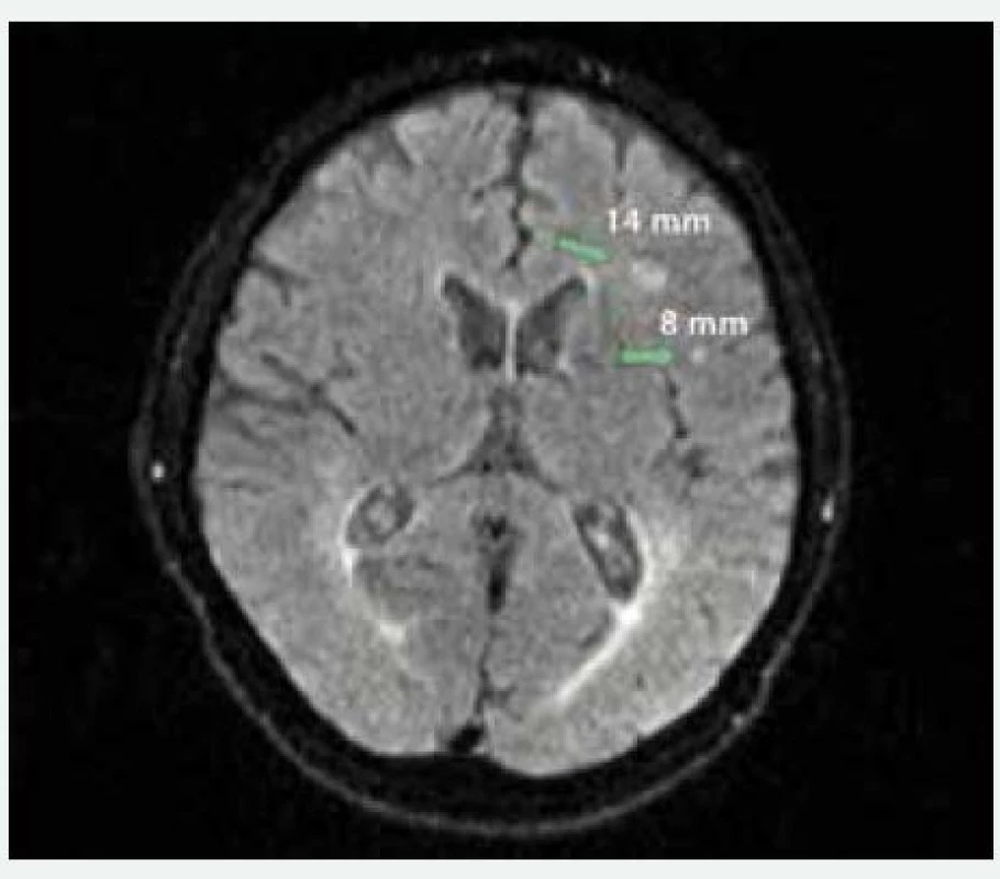 MRI mozku pacienta indikovaného ke katetrizační ablaci fibrilace síní. Šipky označují asymptomatické mozkové léze