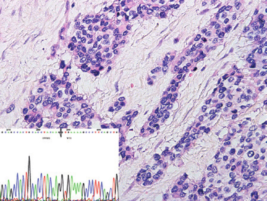 Kazuistika 11. Desmoplastický kulatobuněčný nádor. Nádorové buňky v typických pseudoinsulárních útvarech infiltrují vazivové stroma. V diagnóze nádoru je vhodné kombinovat imunohistochemické vyšetření s molekulárním s průkazem zapojení genu WT1 a genu EWS. Barveno hematoxylinem a eozinem (původní zvětšení 200x). Vložený obrázek: Sekvenogram znázorňující fúzní gen EWSR1/WT1. Šipkou je znázorněna alternativní fúze exonu 5 genu EWSR1 s exonem 10 genu WT1.
