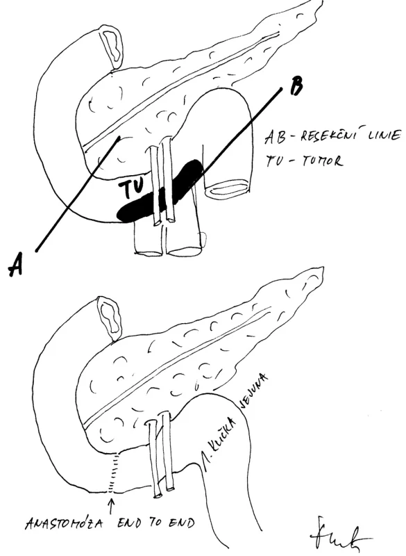 Přímá end to end anastomóza retrokolicky protaženou kličkou jejuna mezi dvanáctníkem a jejunem
Fig. 5: Direct, end-to-end retromesenteric connection between the duodenum and the jejunum, through the jejunal loop