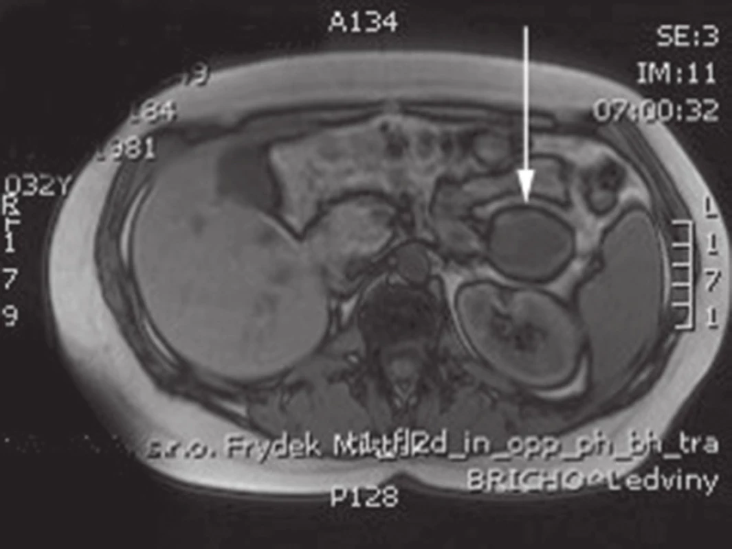 MRI s nálezem SPN v oblasti kaudy pankreatu
Fig. 2: Abdominal MRI with the finding of SPN of the pancreatic tail