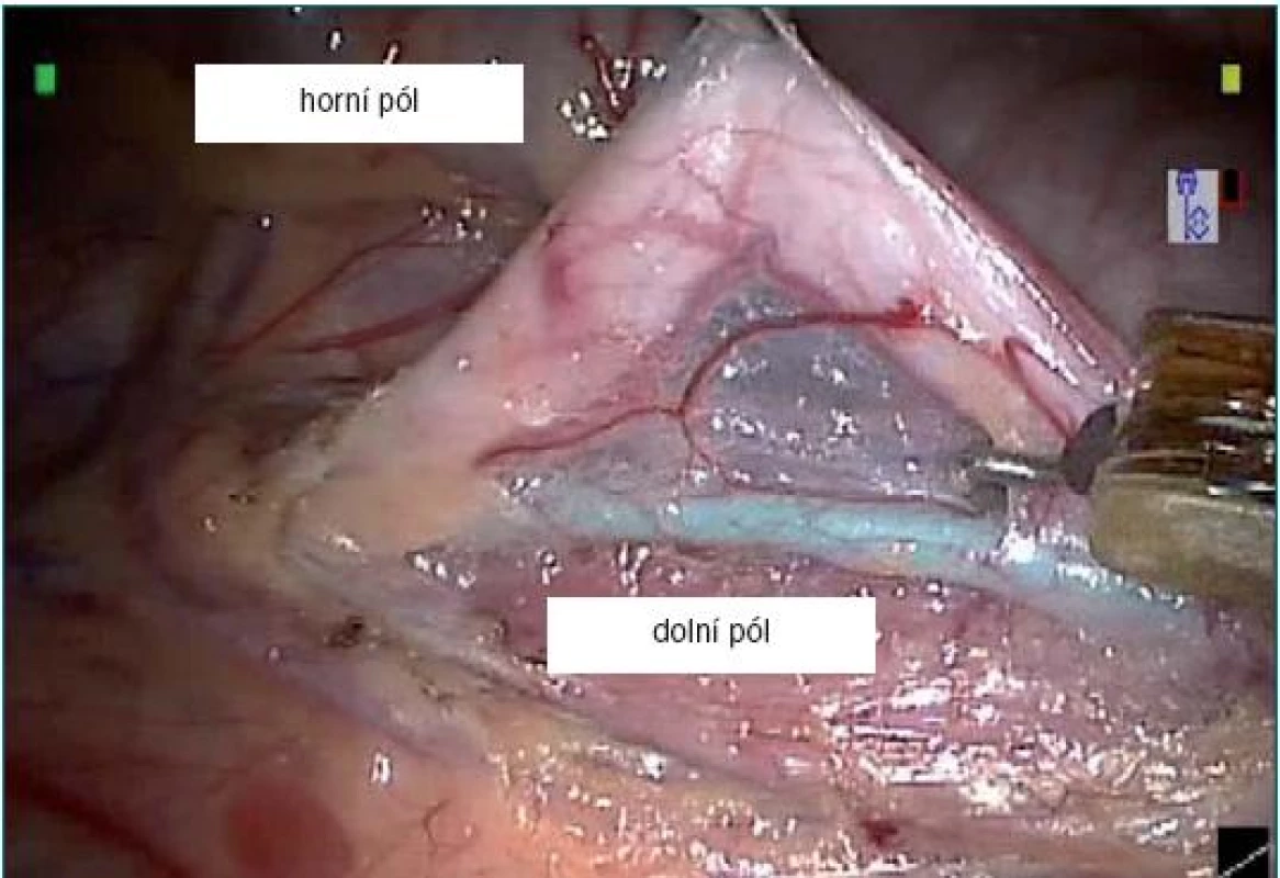 Delineace močovodu horního pólu od močovodu dolního pólu. 3F ureterální katétr (zelená barva) s otevřeným koncem je zaveden do močovodu dolního pólu.
