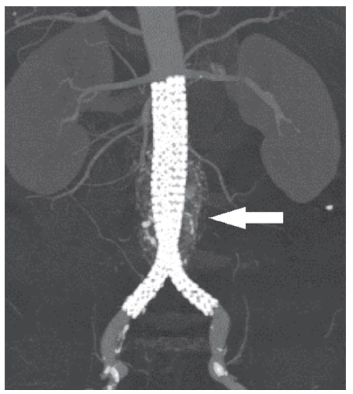 CT angiografie po implantaci
Fig. 3: Post-implant CT angiography
