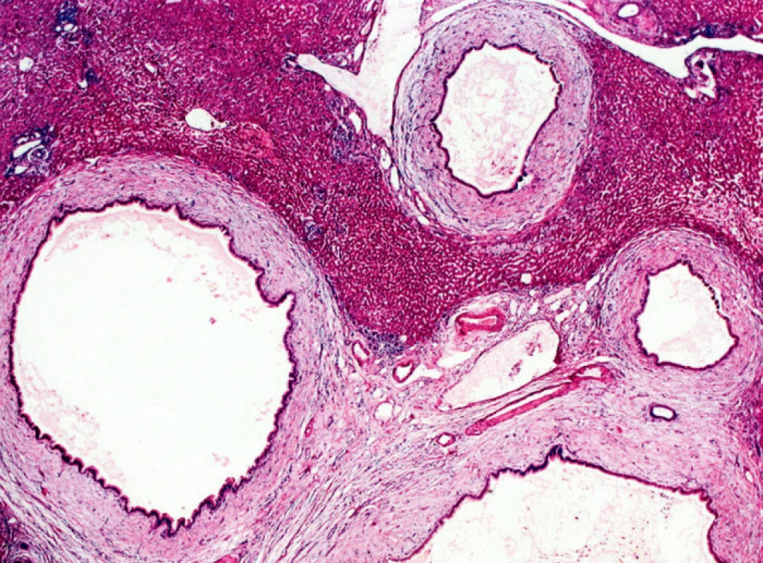 Dilatované žlučovody s cholestázou a hepatolitiázou, HE 20x
Fig. 5. Dilated bile ducts with cholestasis and hapatolithiasis, HE 20x