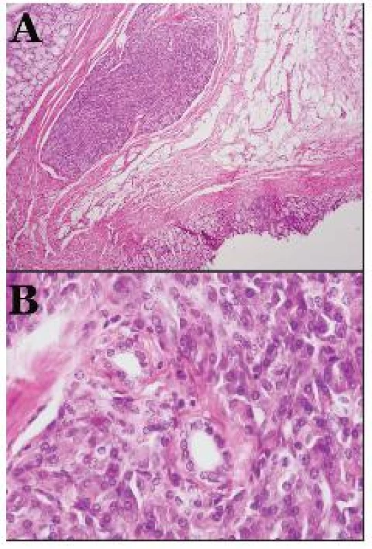 Histologický obraz heterotopického pankreasu (A – ložisko heterotopického pankreasu v submukóze (hematoxilin-eozín, 40x); B – malé pankreatické vývody (hematoxilin-eozín, 400x)
Obr. 3. Histological picture of heterotopic pancreas (A – lesion of heterotopic pancreasu in submucous (hematoxilin-eosin, 40x); B – little pancreatic dusts (hematoxilin-eosin, 400x)