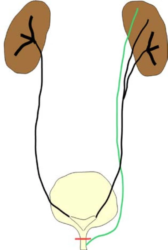 &lt;i&gt;Ureter triplex, ektopické, sub-sfinkterické vyústenie močovodu horného segmentu vľavo&lt;/i&gt;
Fig. 6. &lt;i&gt;Ureter triplex, ectopic, sub-sphincteric position of the left ureter of the upper segment&lt;/i&gt;