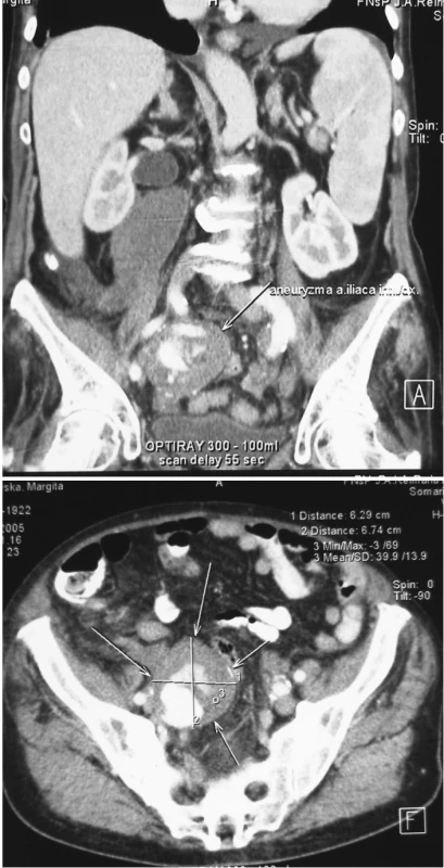 a, b. Pacient č. 1. CT obraz izolovanej aneuryzmy a. iliaca interna vpravo s hematómom v retroperitoneu siahajúcim až po obličku, prítomná hepatosplenomegália
Pic. 1a, b. Patient Nr. 1: A CT scan of an isolated aneurysm of the internal iliac artery on the right with retroperitoneal hematoma, spreading perirenaly.Hepatosplenomegaly is detected