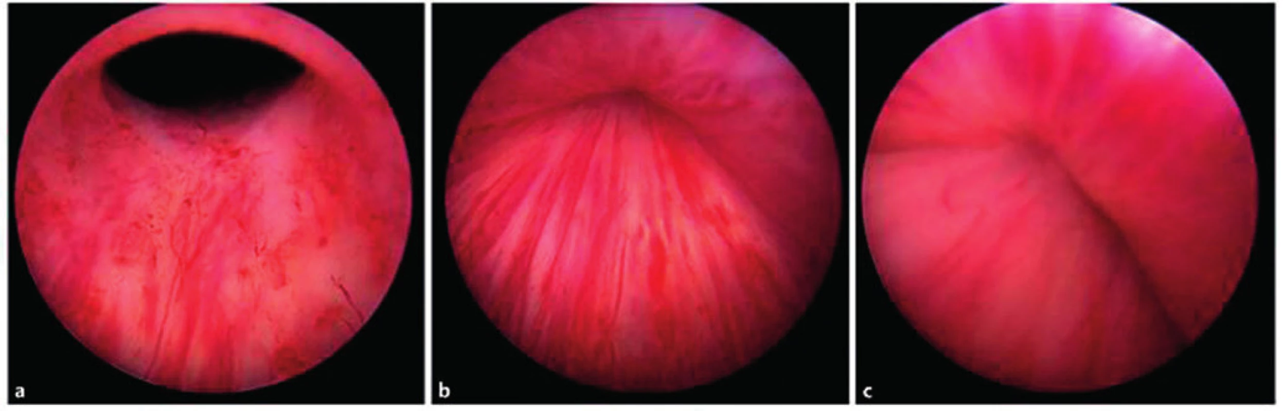 Peroperační endoskopické fotografie oblasti proximální uretry a hrdla močového měchýře, na nichž je patrný mechanismus účinku periuretrálních implantátů – obturace močové trubice