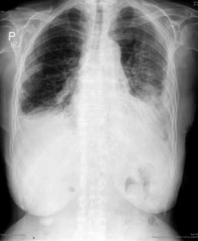 RTG hrudníku: pneumonie vlevo