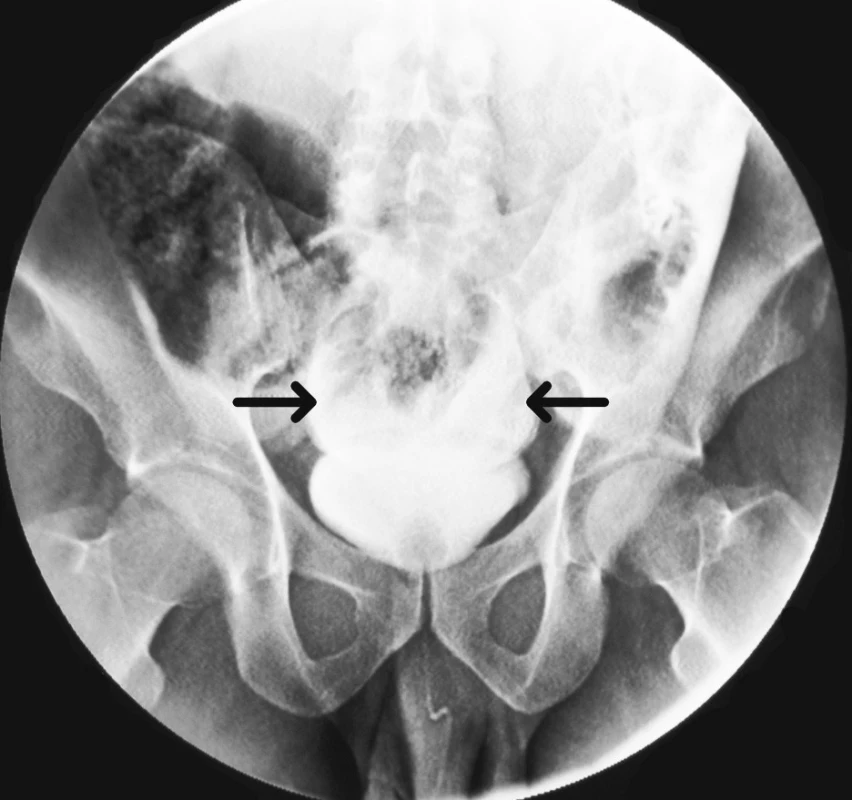 Retrográdní cystogram prokazující únik kontrastní látky do peritoneální dutiny (označeno šipkami)
Fig. 1. Retrograde cystogram showing leak of contrast into the peritoneal cavity (arrows)