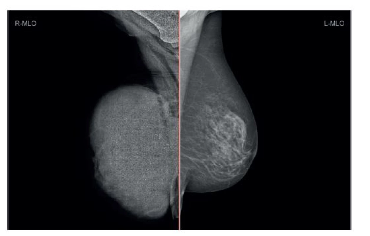 Maligní fyloidní tumor pravého prsu – anamnéza 5 let, váha 4000g, karcinom levého prsu
Fig. 6: Malignant phyllodes tumour of the right breast – history of five years, weight of 4000 grams, carcinoma of the left breast
