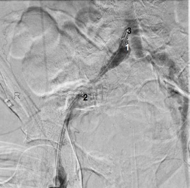 Poloha stent graftu v ilické tepně vpravo. 1) Začátek stent graftu, 2) konec stent graftu, 3) katétr ve společné ilické tepně vpravo
Fig. 4 Location of the stent graft of iliac artery (right). 1) the beginning of the stent graft, 2) the end of the stent graft, 3) catheter in the common iliac artery (right)