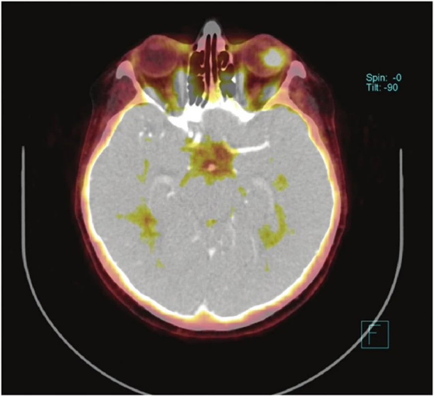PET CT − Uveální forma maligního melanomu
Fig. 1: PET CT − Uveal form of melanoma