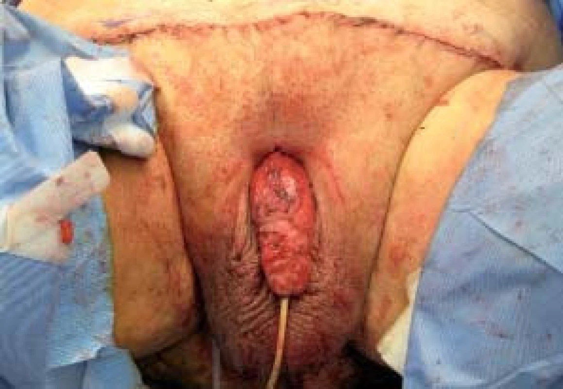 Po excizi nadbytečné kůže a tukové tkáně jsou pubická kůže a báze penisu fixovány k fascii přímého svalu břišního. Rána je pak uzavřena po vrstvách se zavedeným drénem.