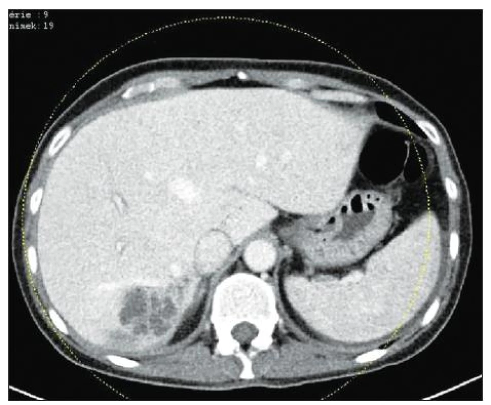 CT obraz dilatace žlučových cest v 6. jaterním segmentu
Fig. 1. CT image of bile duct dilatation in the 6th hepatic segment